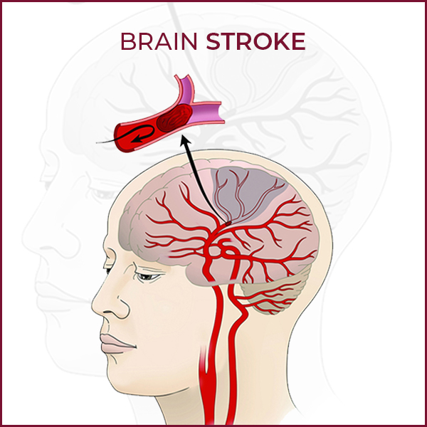 Post Stroke Care